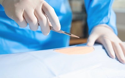 Вшивание ампулы от алкоголизма - Квинмед Вшивание ампулы от алкоголизма - Квинмед